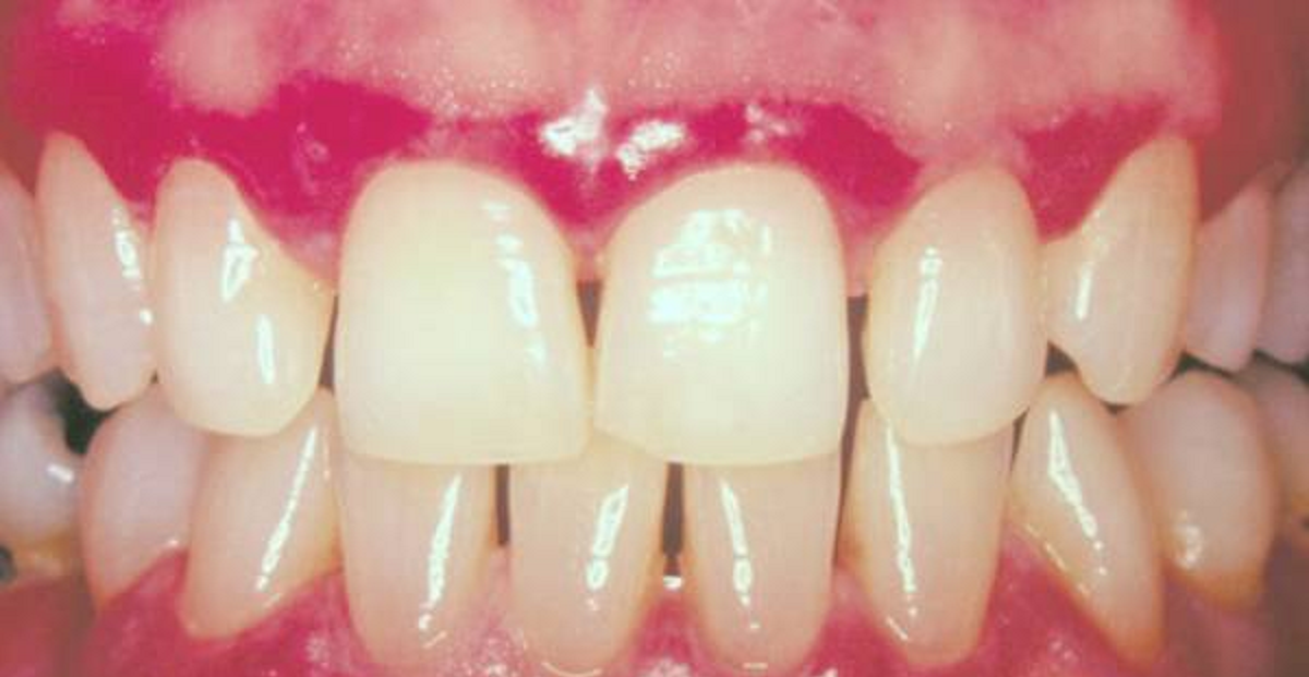 همه چیز درباره عفونت لثه و علل عفونت لثه و روش های درمان