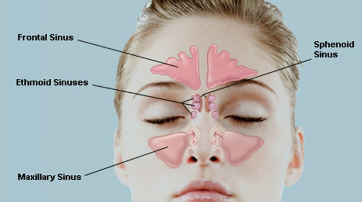 علائم و نشانه‌های سینوزیت مزمن و حاد و علل، تشخیص، درمان و پیشگیری از آن