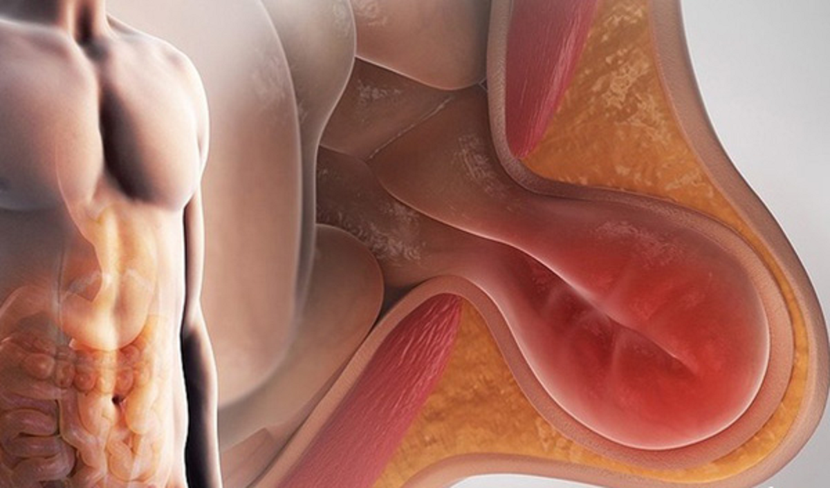 فتق یا باد فتق چیست و  علل، انواع و راه‌های درمان باد فتق