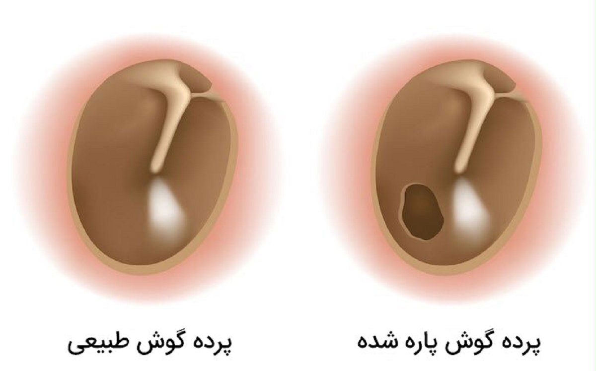 روش خارج کردن جرم یا واکس از درون گوش بدون آسیب رساندن