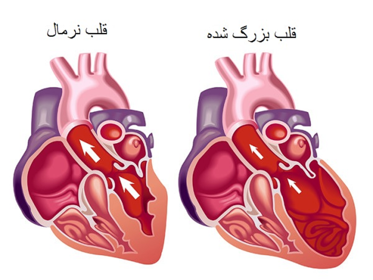 دلایل بزرگ شدن قلب یا کاردیومگالی و روش های درمان این بیماری قلبی
