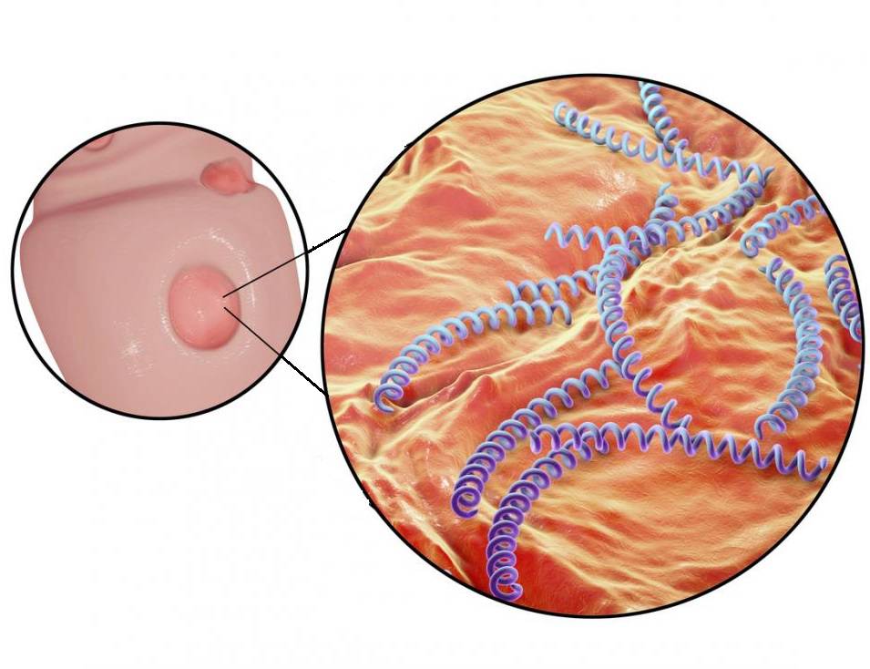 همه چیز درباره بیماری‌های مقاربتی