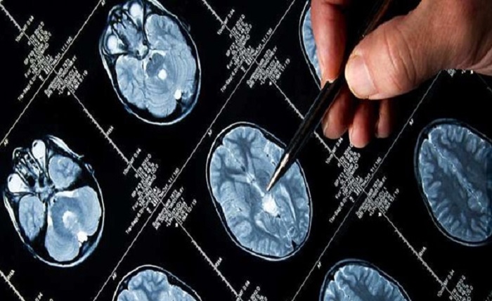 آشنایی با اختلالات غده هیپوفیز