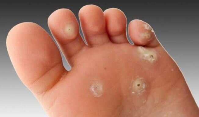 تفاوت زگیل و میخچه در چیست؟