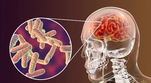 هرآنچه که باید راجع به بیماری مننژیت بدانیم