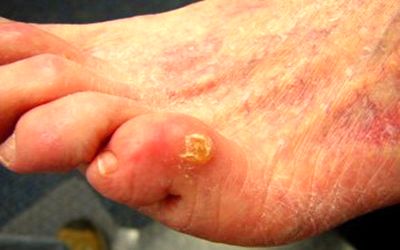 میخچه پا چیست و چگونه درمان میشود؟