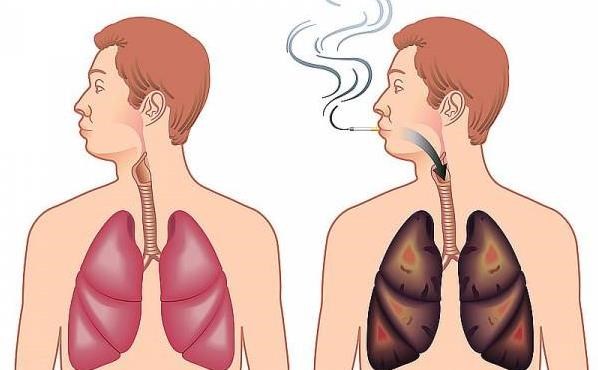 درباره بیماری آمفیزم چه میدانید؟