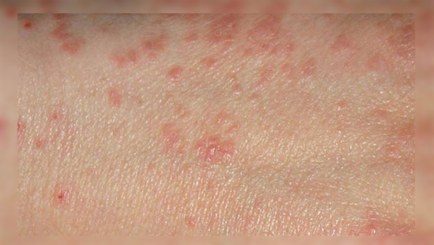 لیکن پلان و روش درمان آن