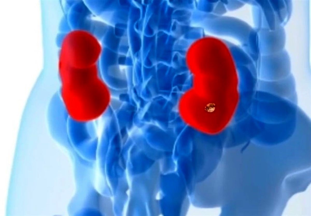 تشخیص و درمان عفونت کلیه
