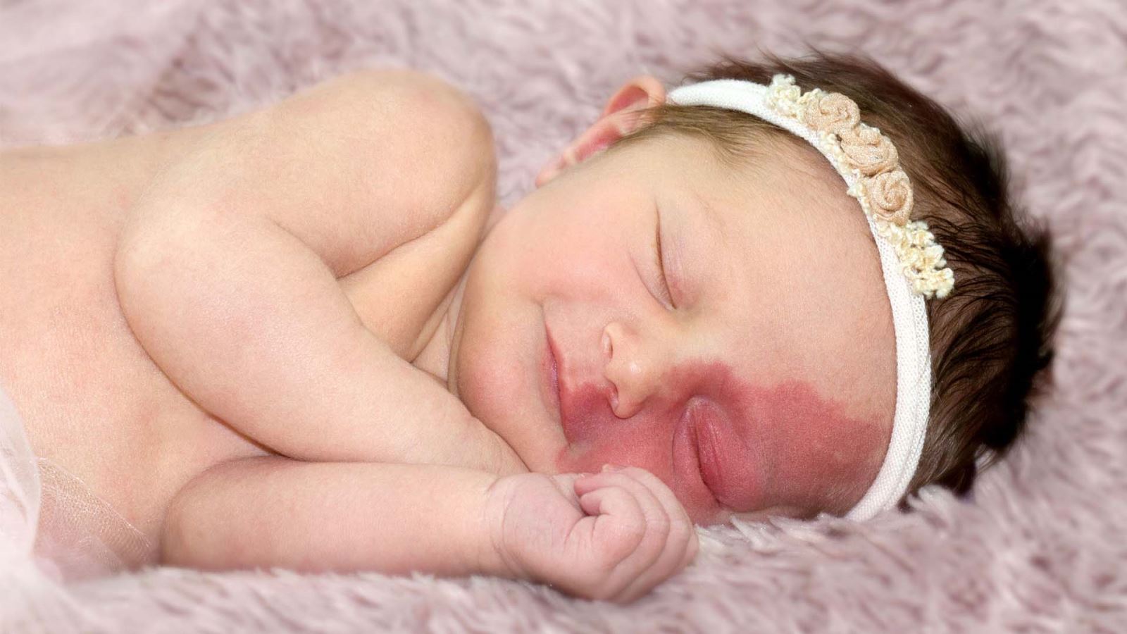 هرآنچه که باید راجع به ماه گرفتگی پوست بدانیم