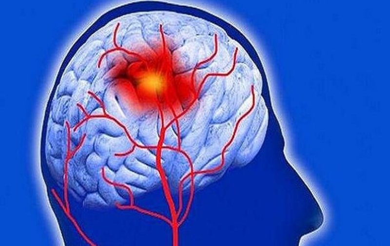 علائم بروز حمله ایسکمیک گذرا را بشناسید