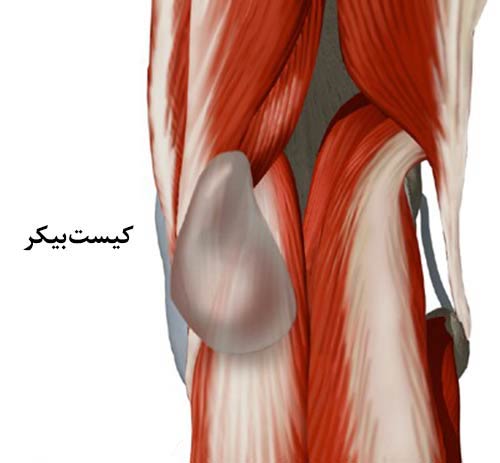 برجستگی پشت زانو یا کیست بیکر