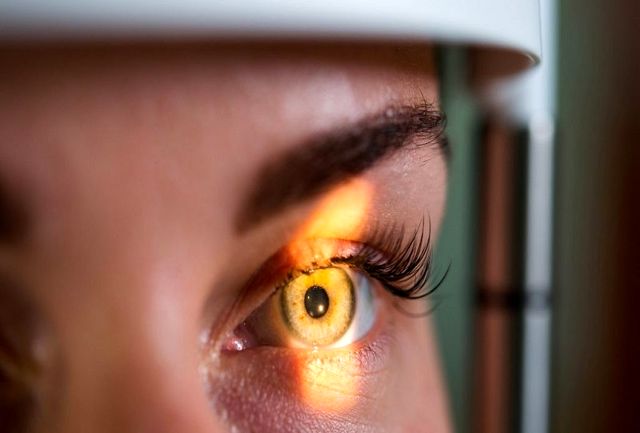 سرطان ملانوم چشمی