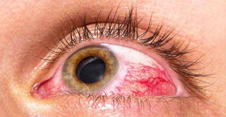 همه جیز راجع به چشم درد