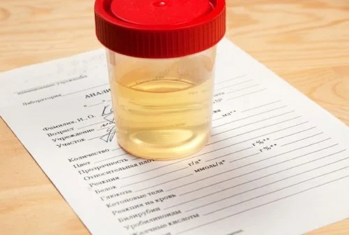 همه چیز درباره تغییر رنگ طبیعی ادرار و ارتباط آن با سلامتی