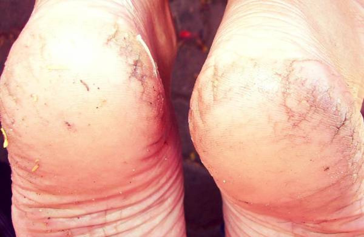 روش‌های معجزه آسا درمان ترک دست و پا