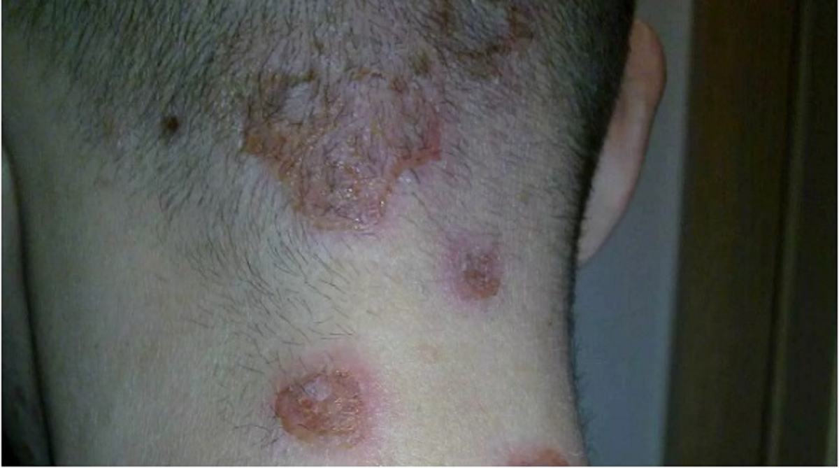 تمام چیزهایی که باید در مورد ضایعات پوستی و علائم و نشانه های آن بدانیم