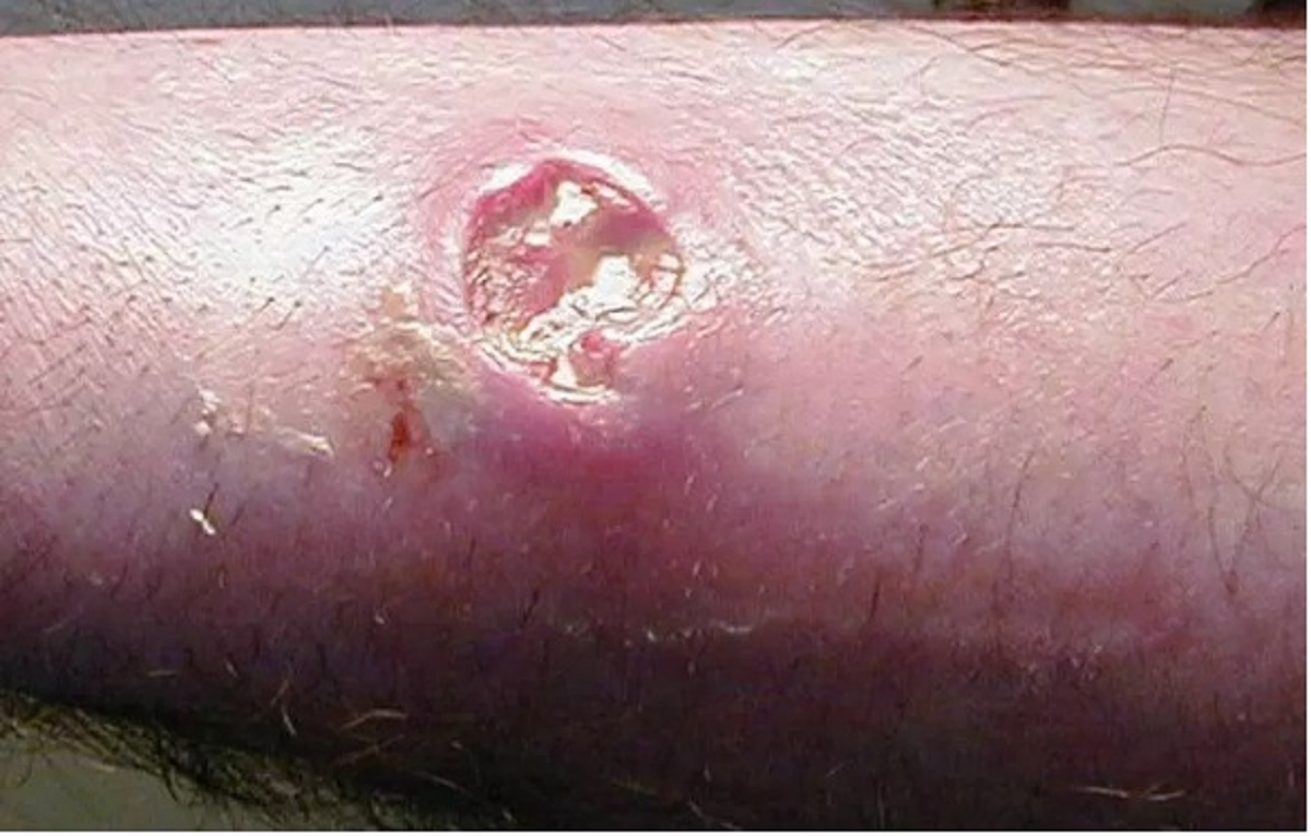 تمام چیزهایی که باید در مورد ضایعات پوستی و علائم و نشانه های آن بدانیم