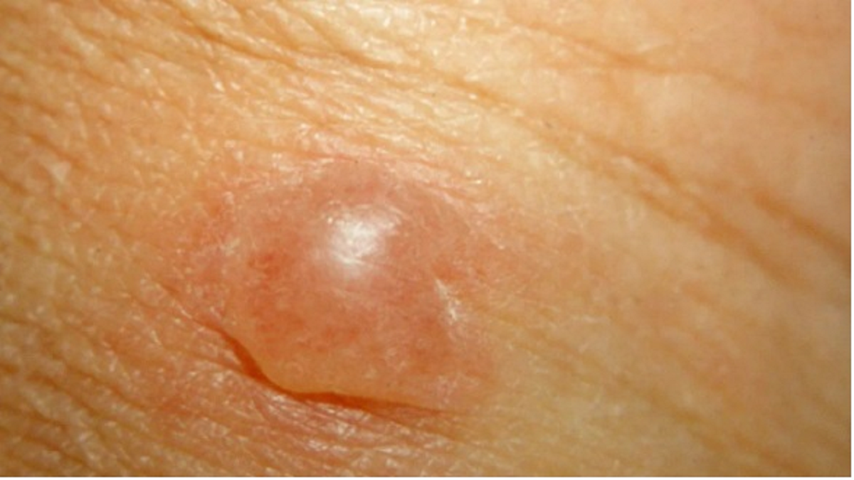 تمام چیزهایی که باید در مورد ضایعات پوستی و علائم و نشانه های آن بدانیم