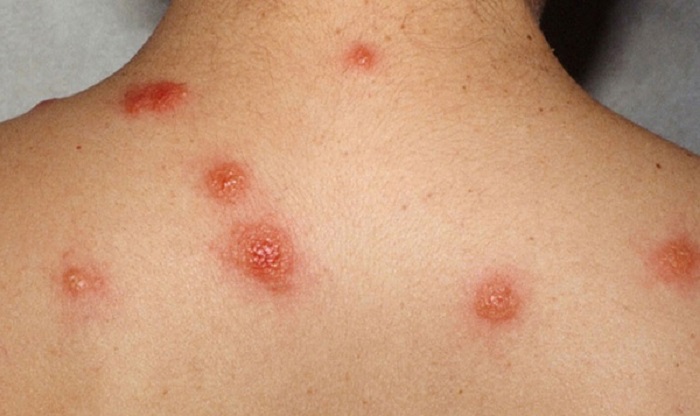 همه چیز راجع به ‌‌‌‌‌بیماری سندرم شیرین