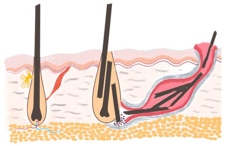 جوش واژن، علل و راه های درمان آن