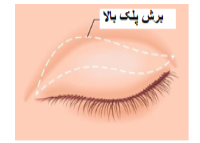 عمل بلفاروپلاستی: افراد مناسب و نامناسب برای انجام عمل زیبایی پلک