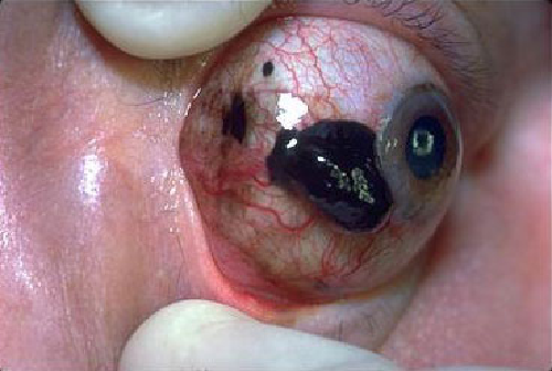 سرطان ملانوم چشمی