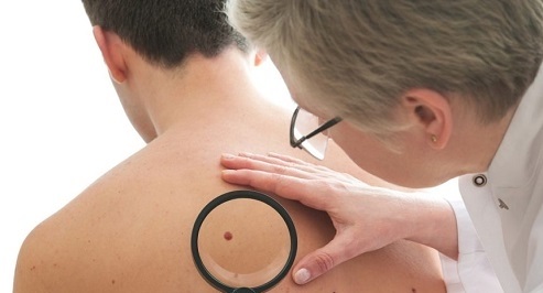 هرآنچه که باید راجع به لکه‌های پوستی بدانیم