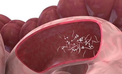 هرآنچه که باید راجع به بیماری کرمک بدانیم