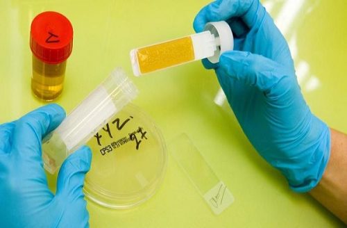 بررسی علل بدبو شدن ادرار و درمان خانگی آن