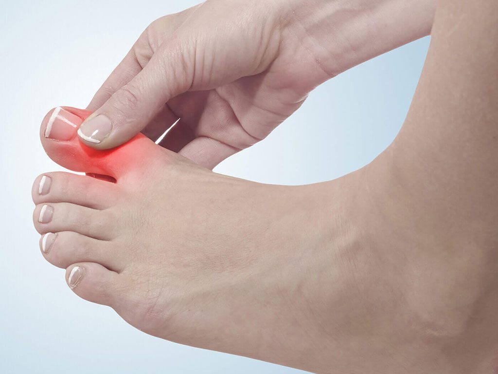 نقرس چیست و چگونه درمان میشود؟