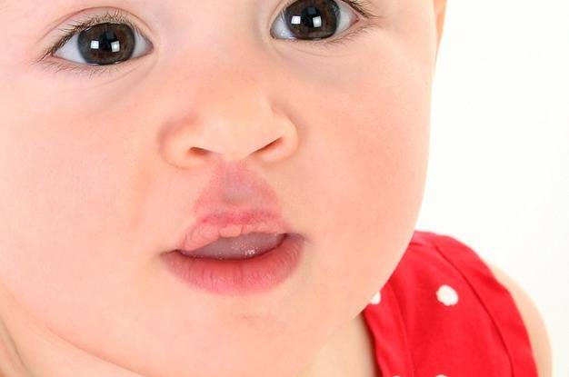 هرآنچه که باید راجع به ماه گرفتگی پوست بدانیم