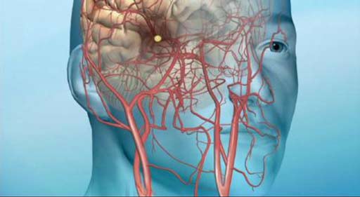 علائم بروز حمله ایسکمیک گذرا را بشناسید