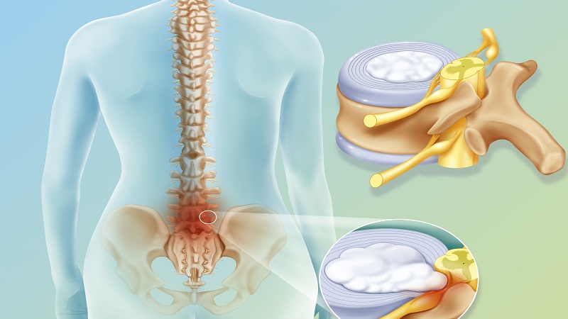 دیسک کمر، علائم و راهکارهای درمانی آن