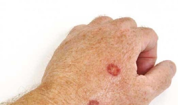 عفونت استاف چیست؟