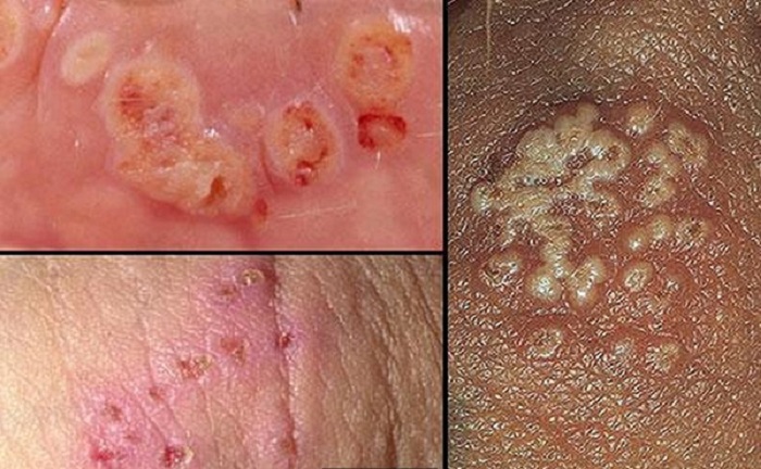 همه چیز راجع به عفونت سیتومگالو ویروس