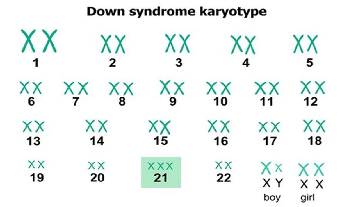 هر آنچه درباره سندروم داون ، علائم،علت‌ ها، راه‌ تشخیص و درمان آن باید بدانیم