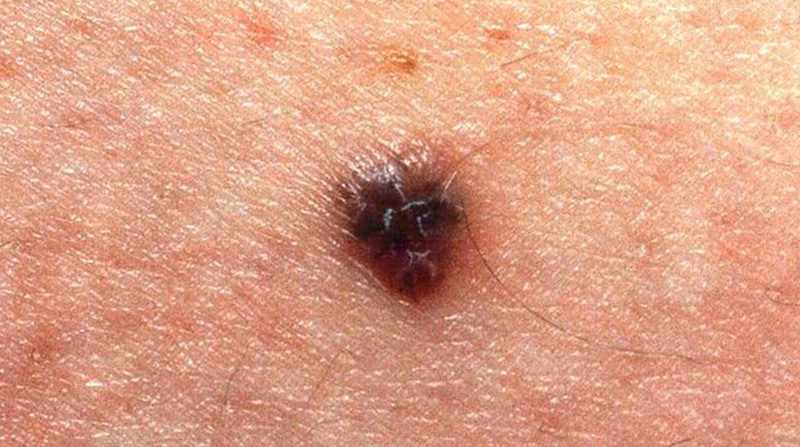 خال سرطانی یا همان ملانوما و راههای درمان آن