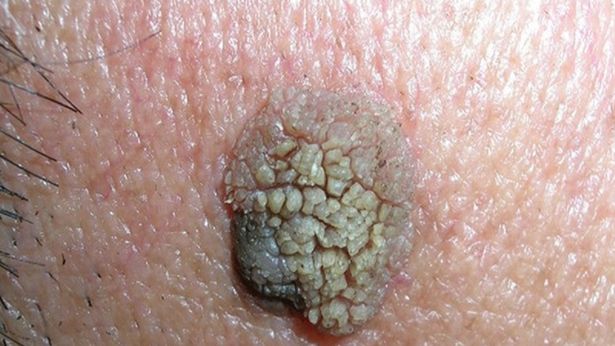 خال سرطانی یا همان ملانوما و راههای درمان آن