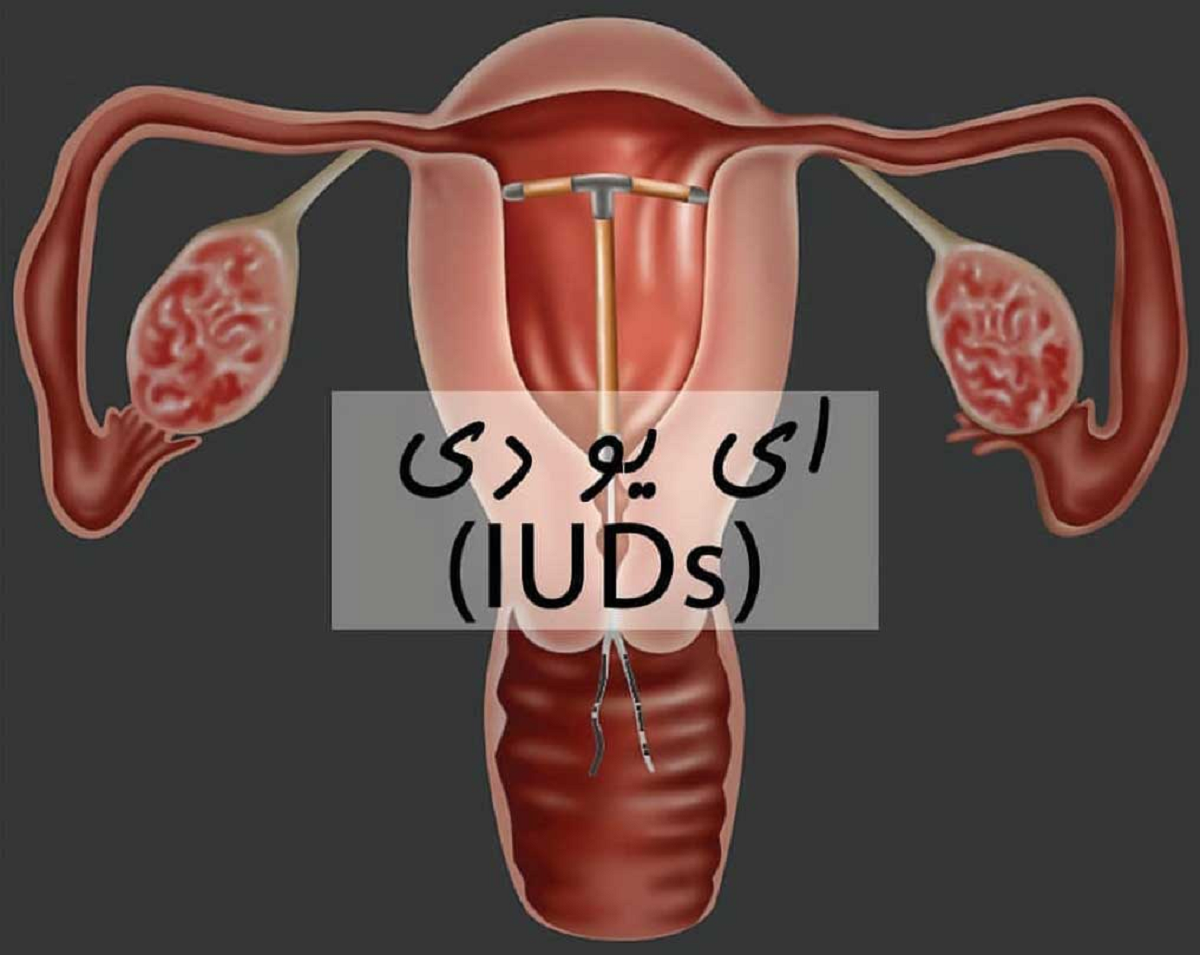 آی یو دی چیست، عوارض و فواید و انواع مختلف آن