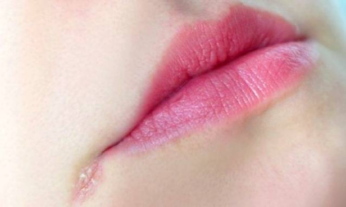 علت و عوامل تیرگی لب ها چیست و چگونه درمان می شود