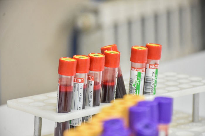 اسید اوریک بالای خون و راههای کاهش آن