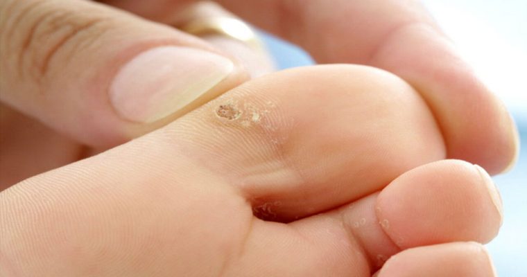 تفاوت زگیل و میخچه در چیست؟