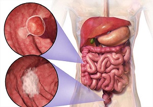 همه چیز در مورد زخم معده و راه حل درمانی آن