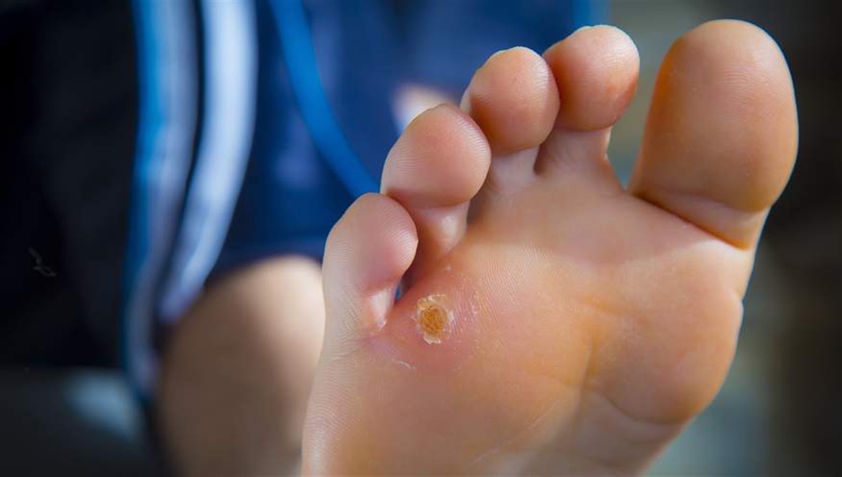 میخچه پا چیست و چگونه درمان میشود؟