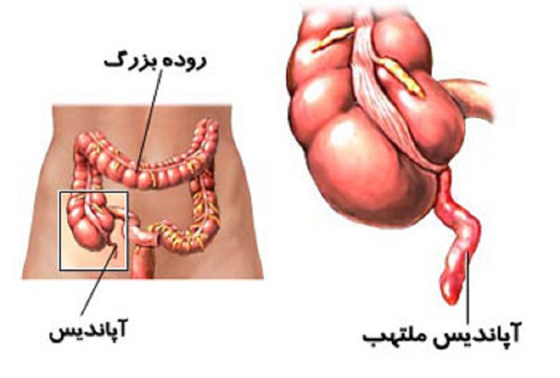 همه چیز درباره آماس آپاندیس