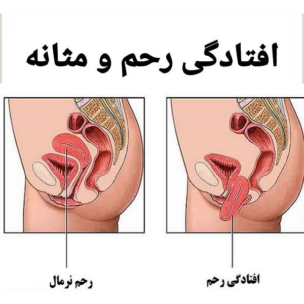 افتادگی مثانه چیست؟