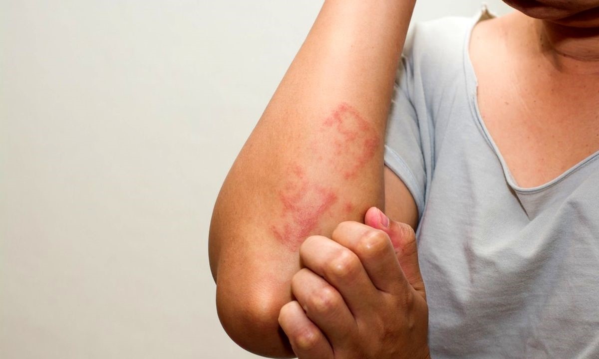 تشخیص و درمان حساسیت غذایی