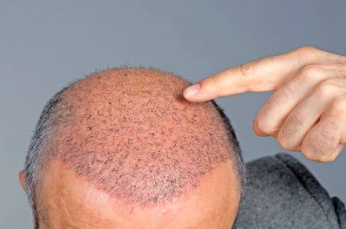 کاشت مو چیست و چه عوارضی دارد؟