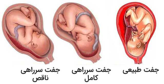 همه چیز درباره جفت سرراهی یا پلاسنتا پریویا